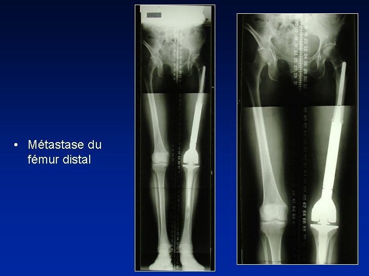  • Métastase du fémur distal 