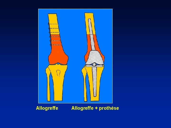 Allogreffe Allogreffe + prothèse 