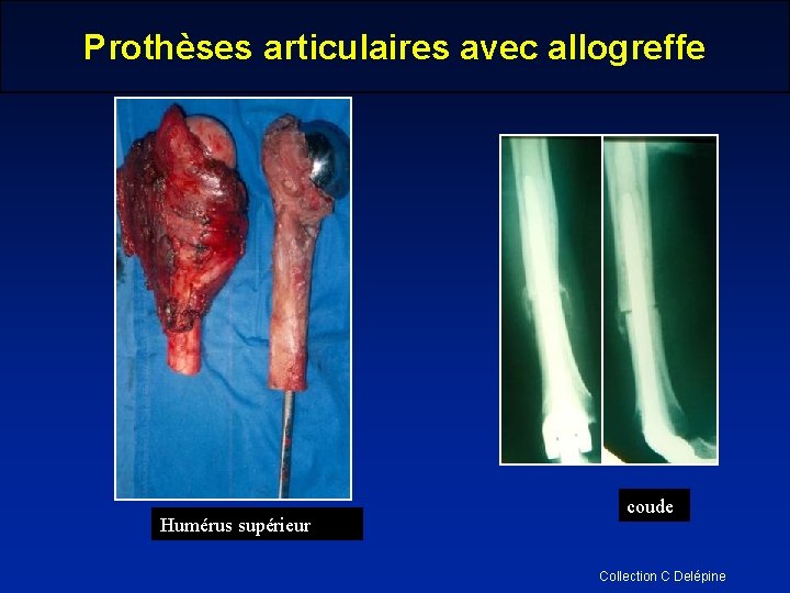 Prothèses articulaires avec allogreffe Humérus supérieur coude Collection C Delépine 