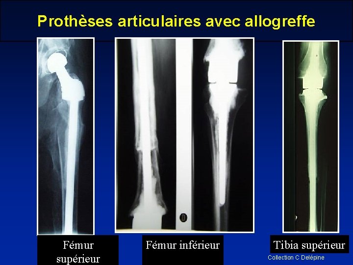 Prothèses articulaires avec allogreffe Fémur supérieur Fémur inférieur Tibia supérieur Collection C Delépine 