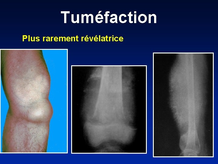 Tuméfaction Plus rarement révélatrice 