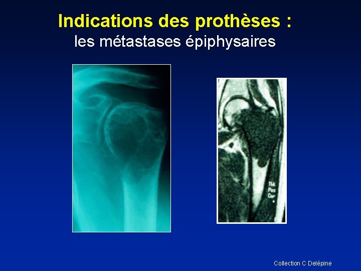 Indications des prothèses : les métastases épiphysaires Collection C Delépine 