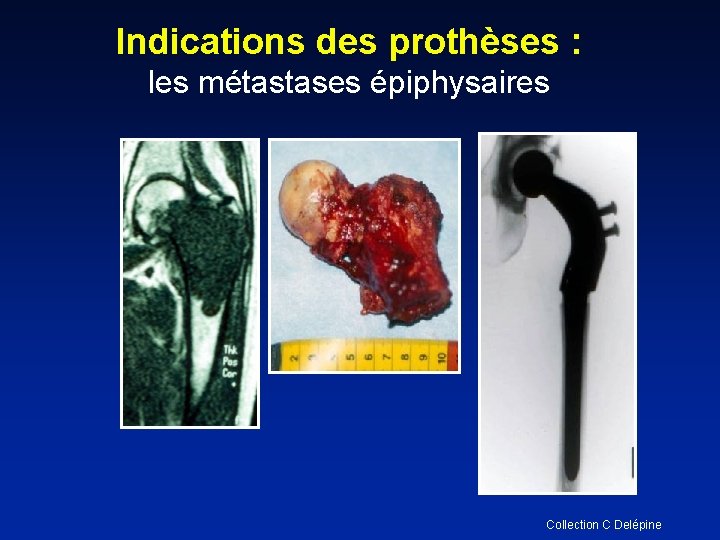 Indications des prothèses : les métastases épiphysaires Collection C Delépine 
