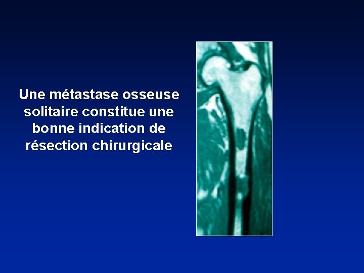 Une métastase osseuse solitaire constitue une bonne indication de résection chirurgicale 
