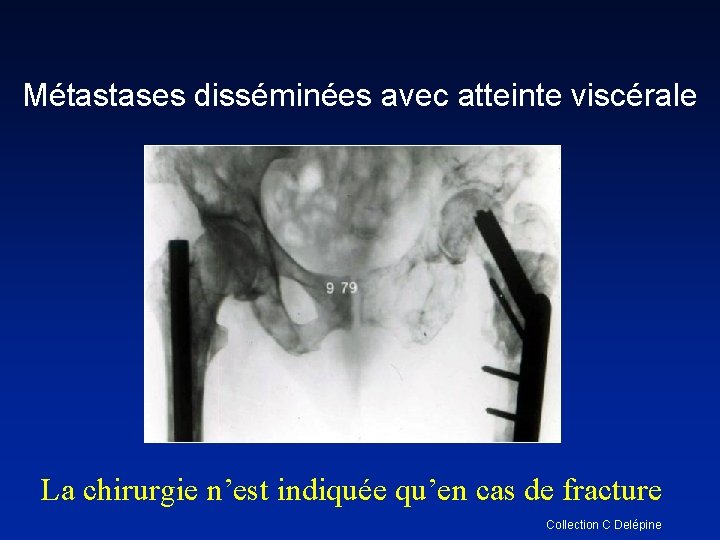 Métastases disséminées avec atteinte viscérale La chirurgie n’est indiquée qu’en cas de fracture Collection