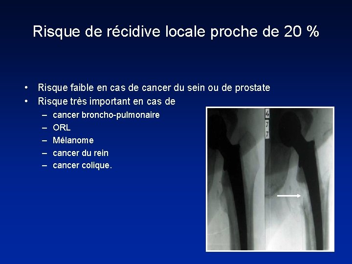 Risque de récidive locale proche de 20 % • Risque faible en cas de