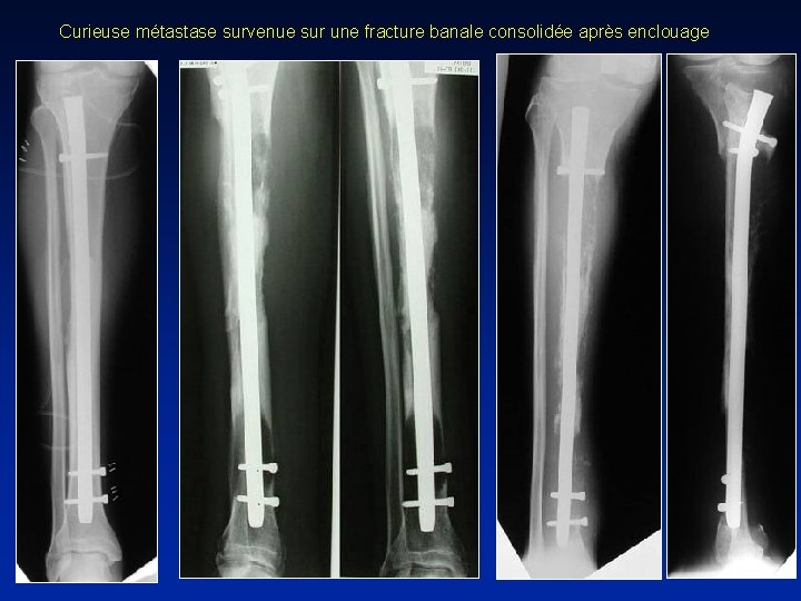 Curieuse métastase survenue sur une fracture banale consolidée après enclouage 