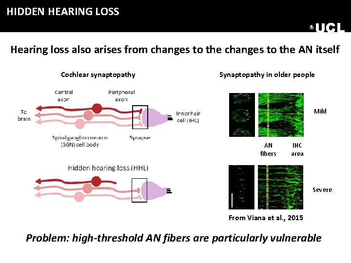 HIDDEN HEARING LOSS UCL Hearing loss also arises from changes to the AN itself HIDDEN HEARING LOSS UCL Hearing loss also arises from changes to the AN itself