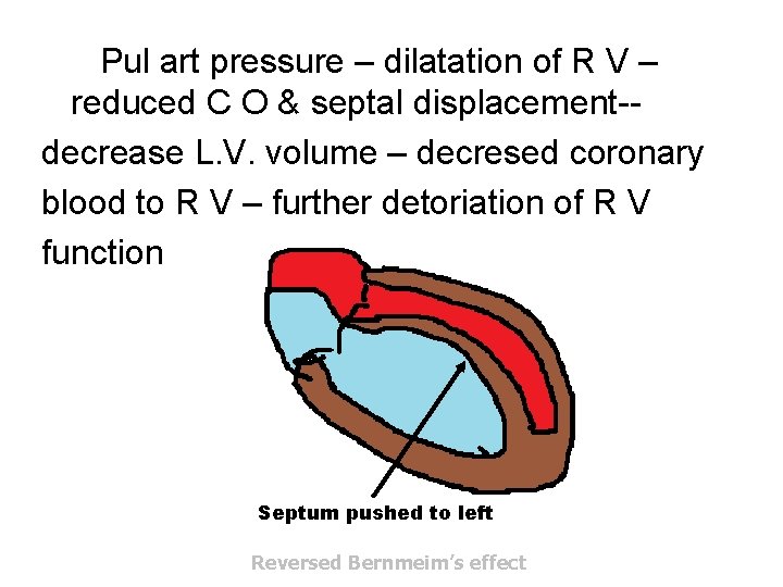 Pul art pressure – dilatation of R V – reduced C O & septal