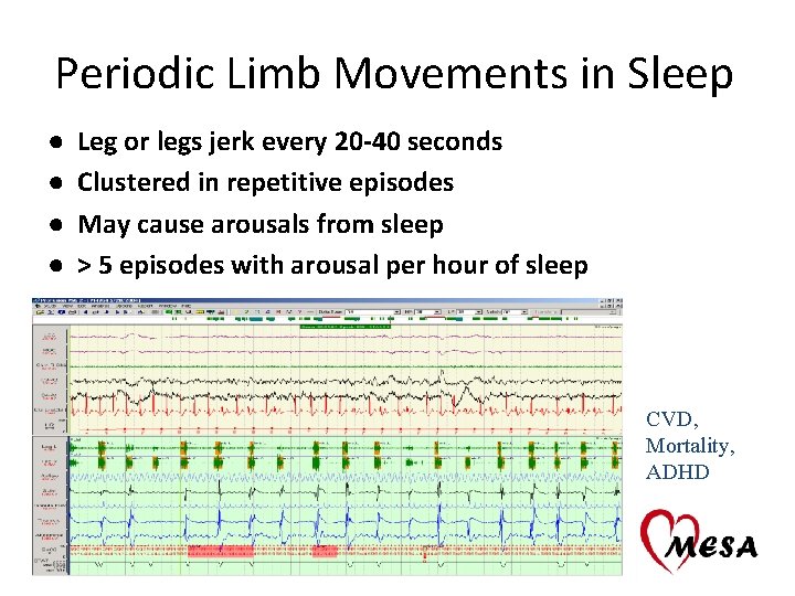 Periodic Limb Movements in Sleep ● ● Leg or legs jerk every 20 -40