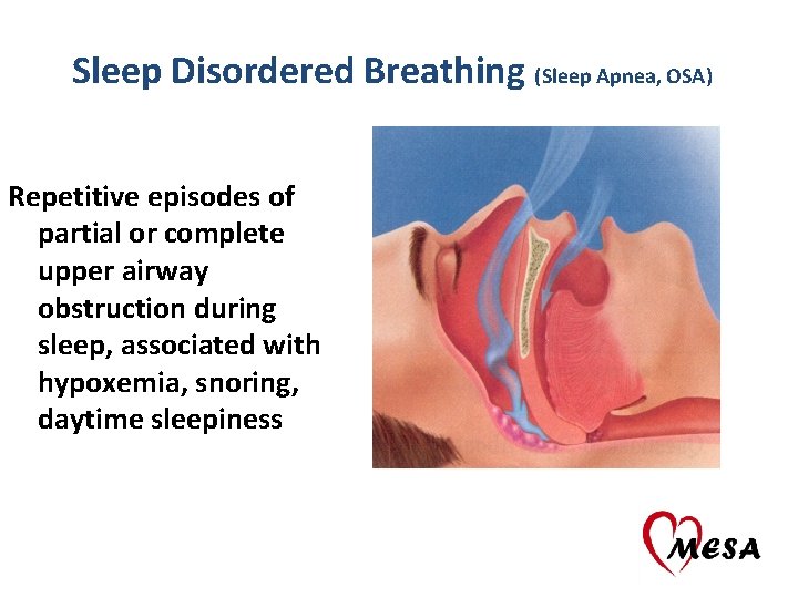 Sleep Disordered Breathing (Sleep Apnea, OSA) Repetitive episodes of partial or complete upper airway