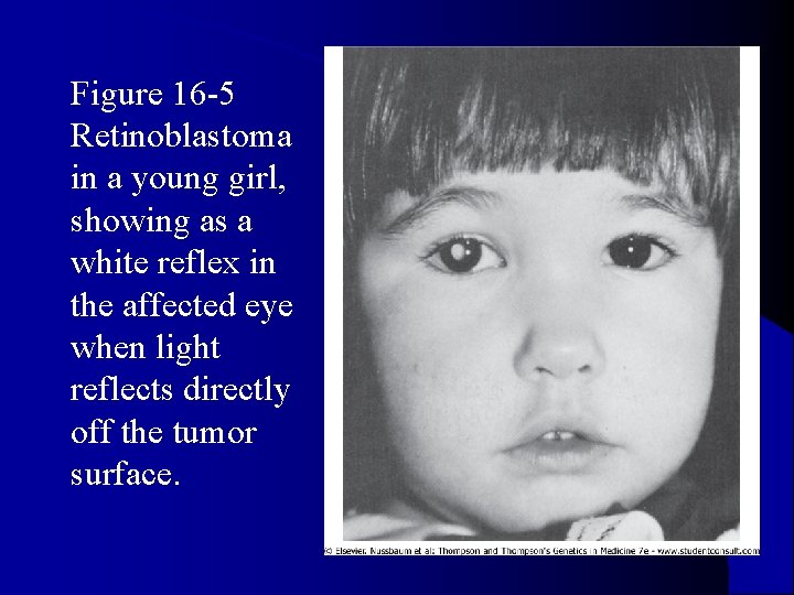l Figure 16 -5 Retinoblastoma in a young girl, showing as a white reflex