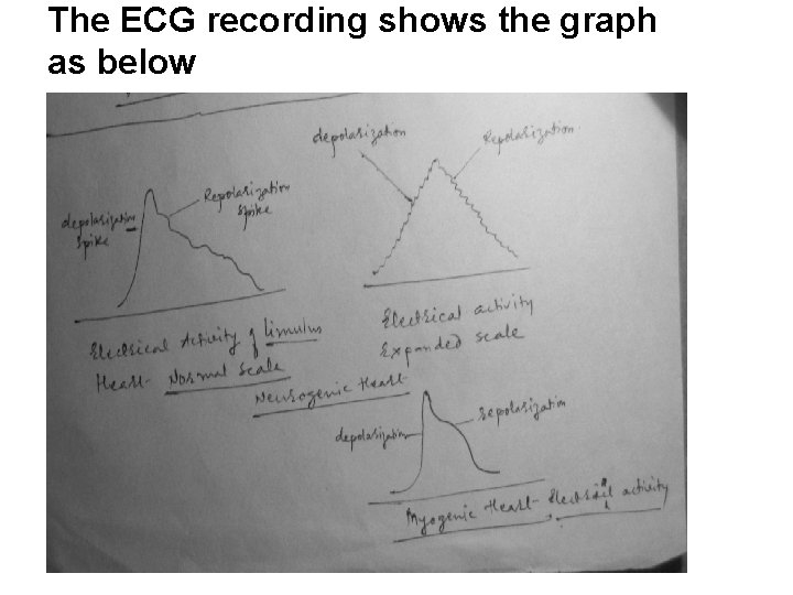 The ECG recording shows the graph as below 