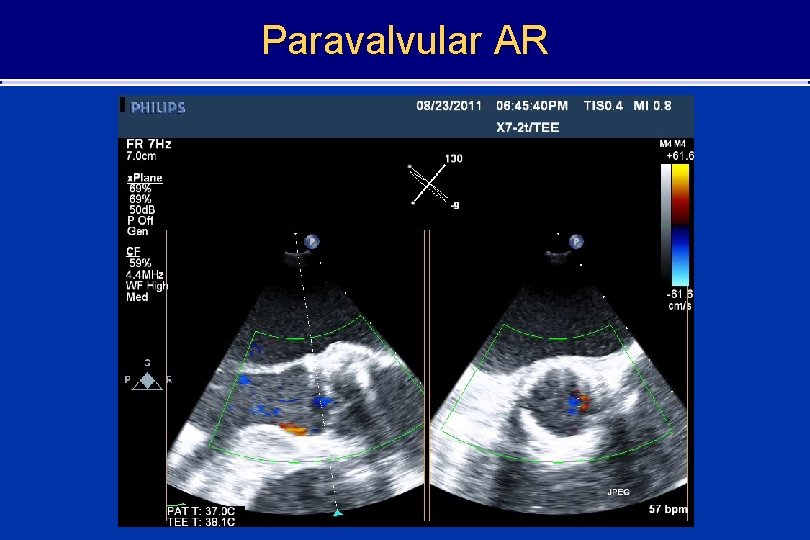 Paravalvular AR 