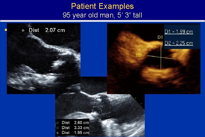 Patient Examples 95 year old man, 5’ 3” tall • 