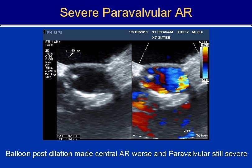Severe Paravalvular AR Balloon post dilation made central AR worse and Paravalvular still severe