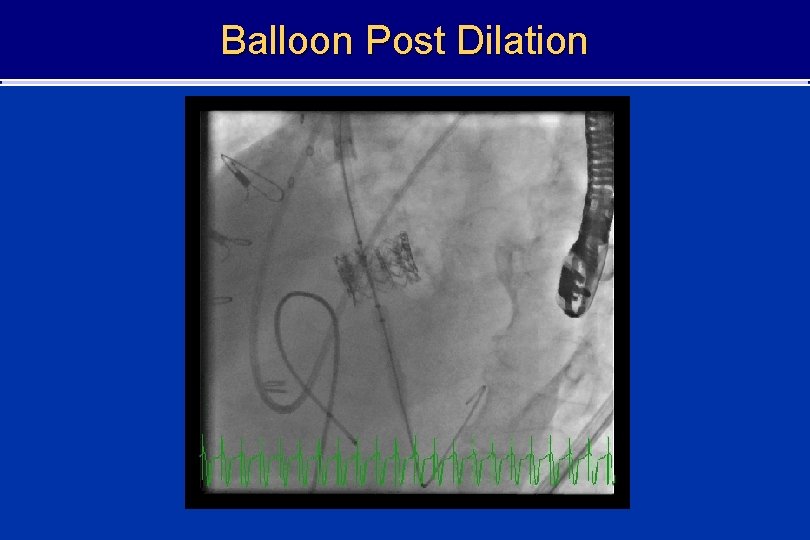 Balloon Post Dilation 