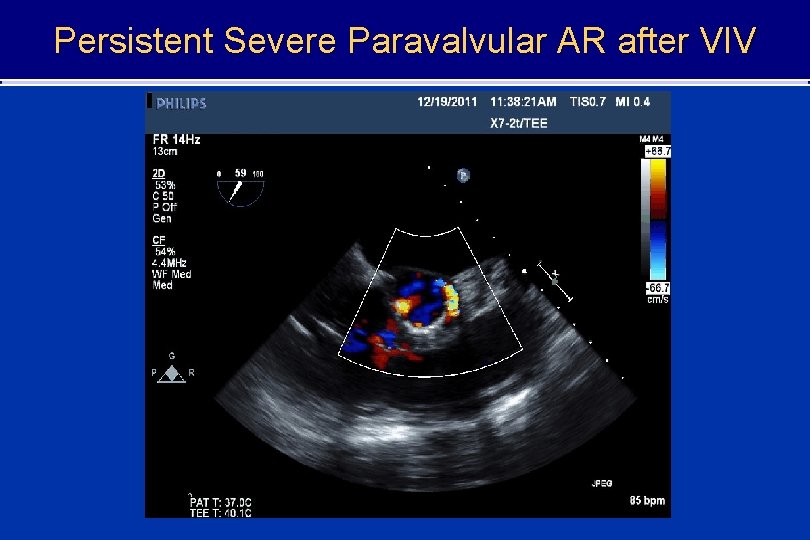 Persistent Severe Paravalvular AR after VIV 