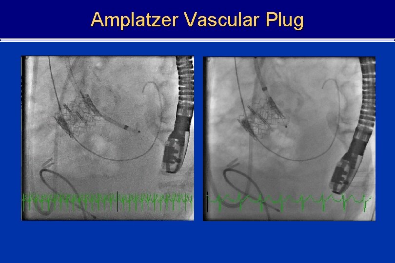 Amplatzer Vascular Plug 