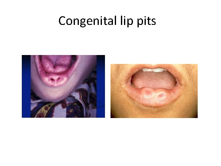 Congenital lip pits 