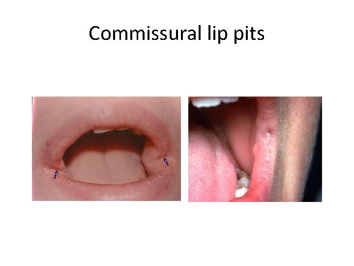 Commissural lip pits 