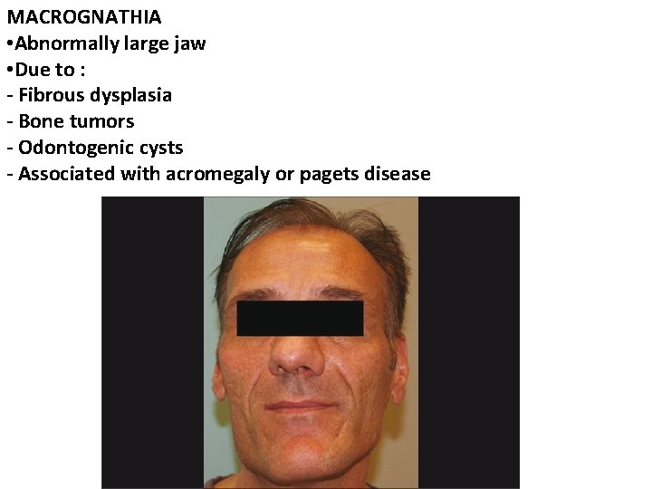 MACROGNATHIA • Abnormally large jaw • Due to : - Fibrous dysplasia - Bone