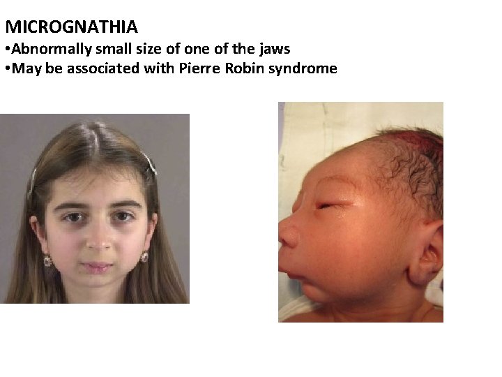 MICROGNATHIA • Abnormally small size of one of the jaws • May be associated