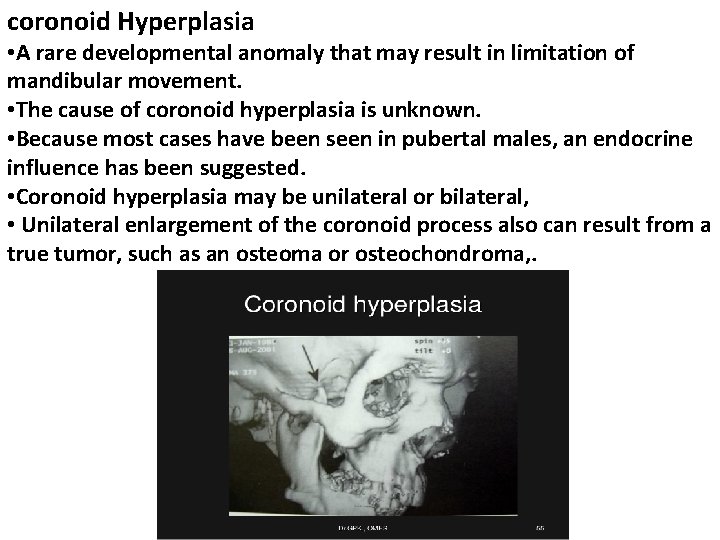 coronoid Hyperplasia • A rare developmental anomaly that may result in limitation of mandibular