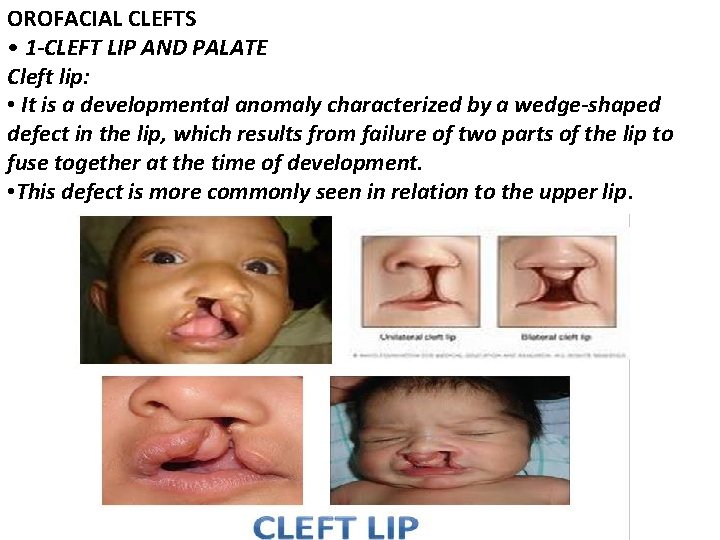 OROFACIAL CLEFTS • 1 -CLEFT LIP AND PALATE Cleft lip: • It is a