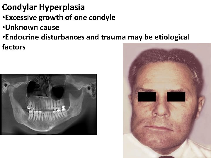 Condylar Hyperplasia • Excessive growth of one condyle • Unknown cause • Endocrine disturbances