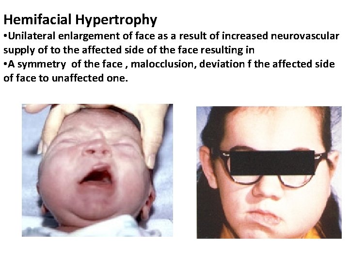 Hemifacial Hypertrophy • Unilateral enlargement of face as a result of increased neurovascular supply