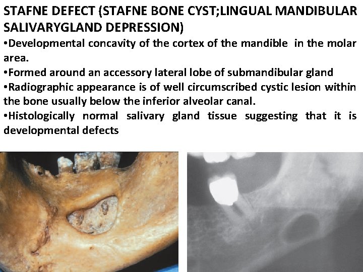 STAFNE DEFECT (STAFNE BONE CYST; LINGUAL MANDIBULAR SALIVARYGLAND DEPRESSION) • Developmental concavity of the