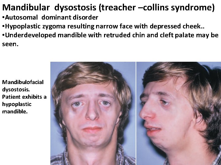 Mandibular dysostosis (treacher –collins syndrome) • Autosomal dominant disorder • Hypoplastic zygoma resulting narrow