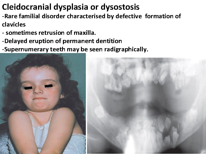 Cleidocranial dysplasia or dysostosis -Rare familial disorder characterised by defective formation of clavicles -