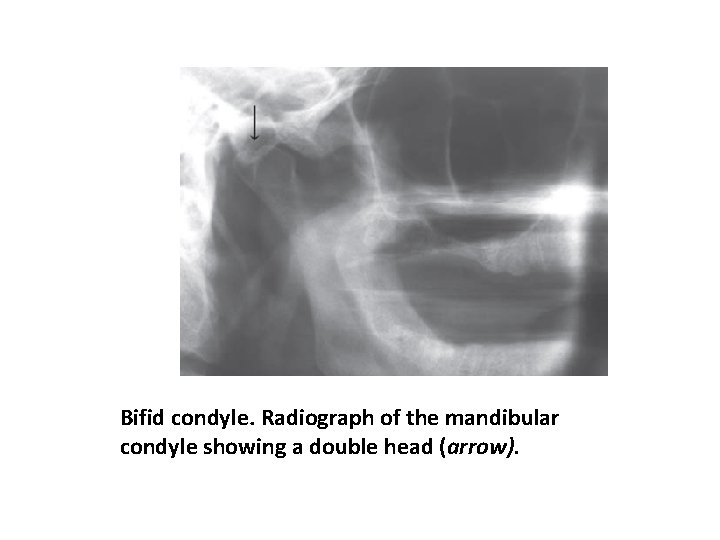 Bifid condyle. Radiograph of the mandibular condyle showing a double head (arrow). 