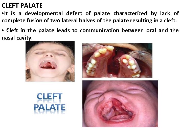 CLEFT PALATE • It is a developmental defect of palate characterized by lack of