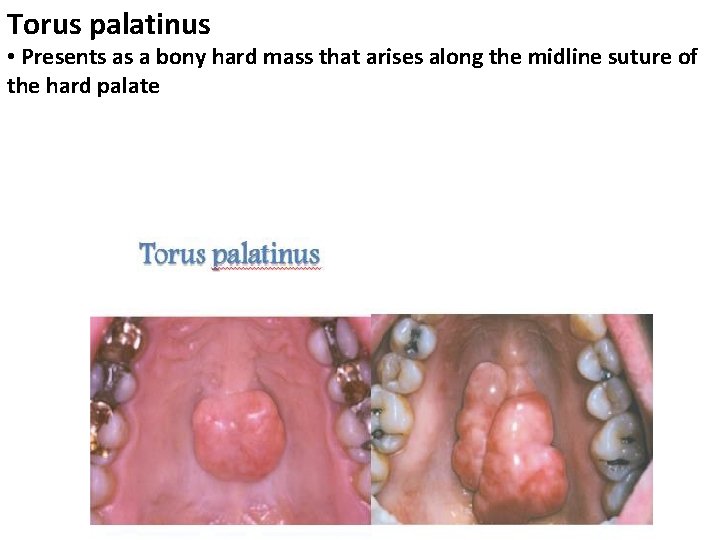 Torus palatinus • Presents as a bony hard mass that arises along the midline