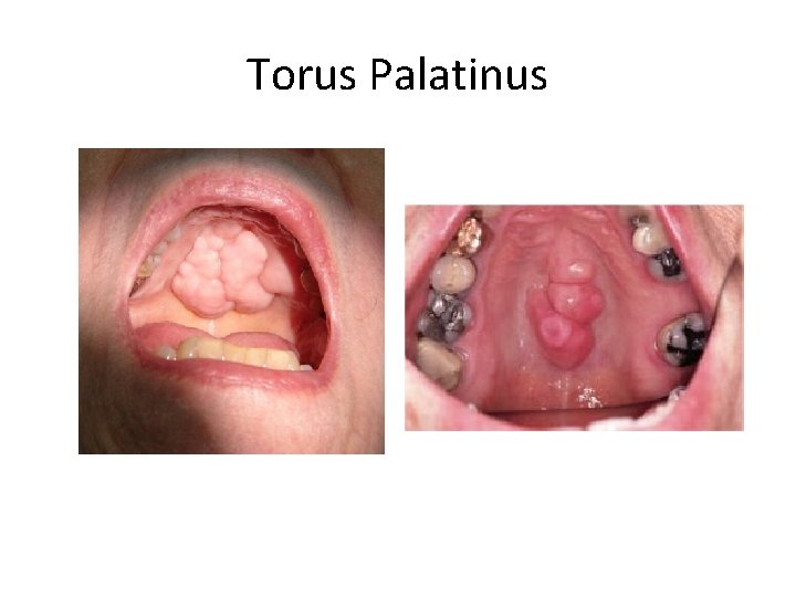 Torus Palatinus 