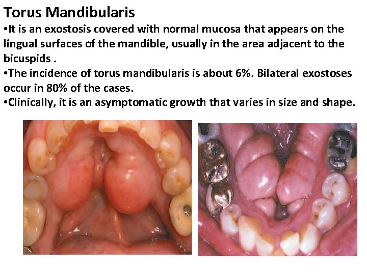 Torus Mandibularis • It is an exostosis covered with normal mucosa that appears on