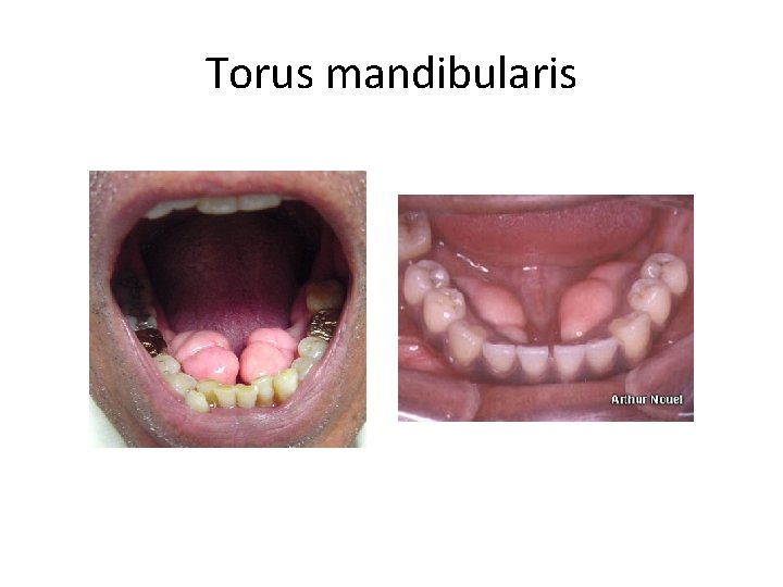 Torus mandibularis 