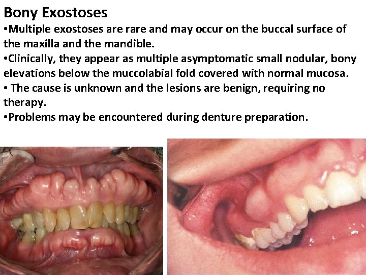 Bony Exostoses • Multiple exostoses are rare and may occur on the buccal surface