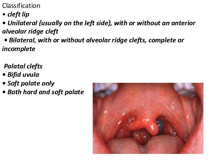 Classification • cleft lip • Unilateral (usually on the left side), with or without