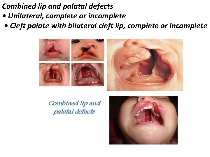 Combined lip and palatal defects • Unilateral, complete or incomplete • Cleft palate with