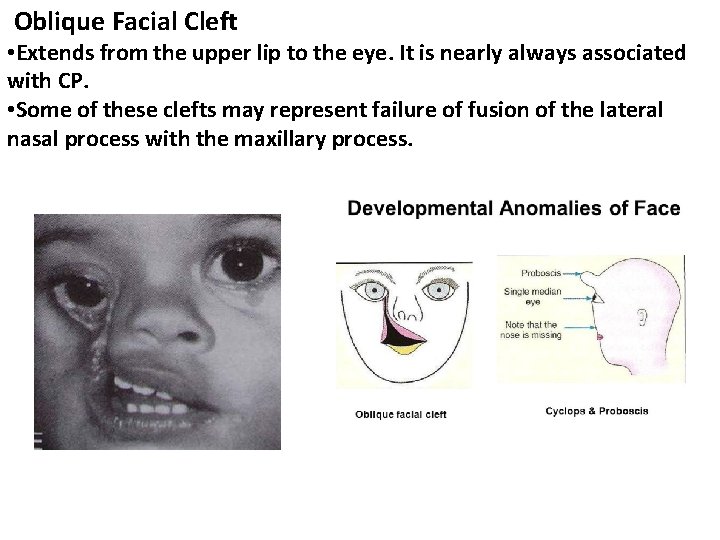 Oblique Facial Cleft • Extends from the upper lip to the eye. It is