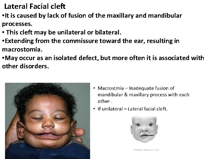 Lateral Facial cleft • It is caused by lack of fusion of the maxillary