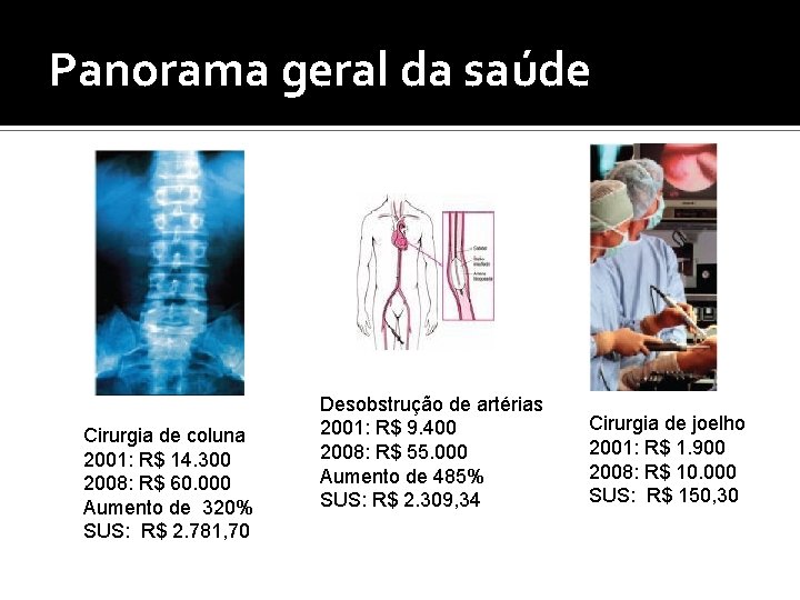 Panorama geral da saúde Cirurgia de coluna 2001: R$ 14. 300 2008: R$ 60.