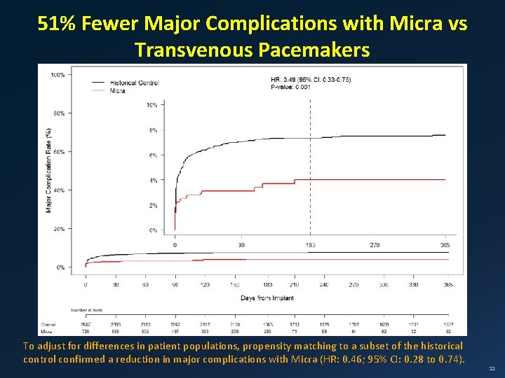 51% Fewer Major Complications with Micra vs Transvenous Pacemakers To adjust for differences in