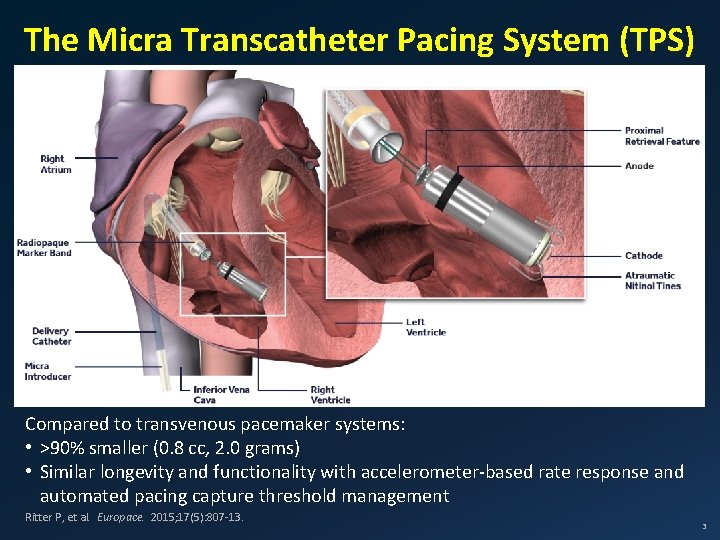 The Micra Transcatheter Pacing System (TPS) Compared to transvenous pacemaker systems: • >90% smaller