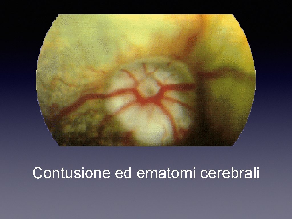 Contusione ed ematomi cerebrali 