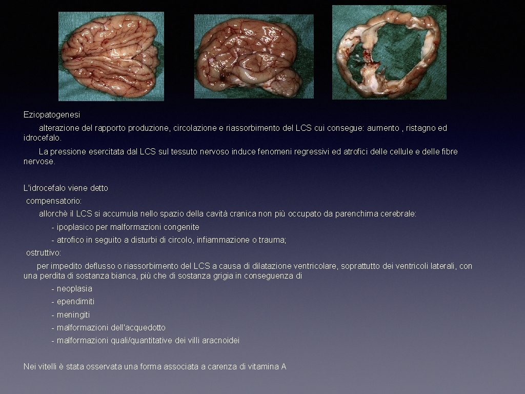 Eziopatogenesi alterazione del rapporto produzione, circolazione e riassorbimento del LCS cui consegue: aumento ,